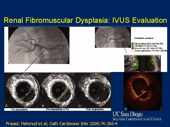 Renal Fibromuscular Dysplasia: IVUS Evaluation Prasad, Mahmud et al; Cath Cardiovasc Intv 2009; 74: