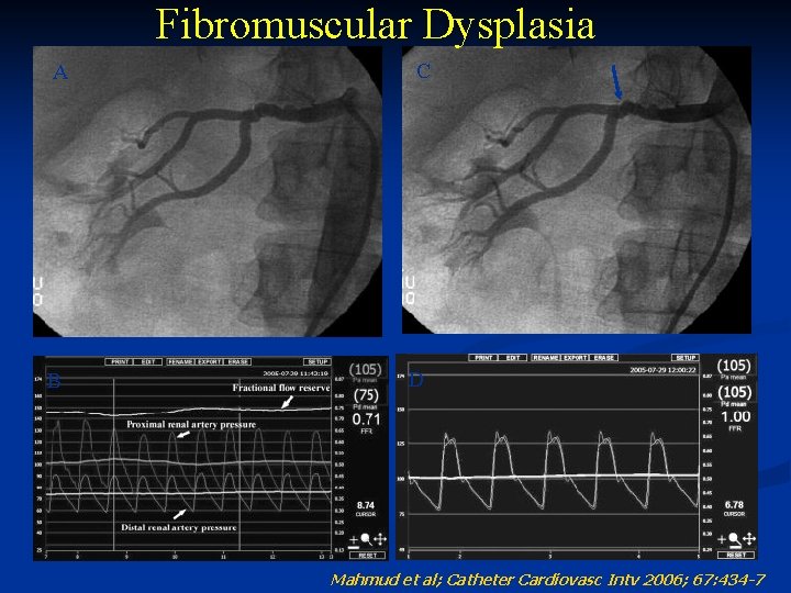 Fibromuscular Dysplasia A B C D Mahmud et al; Catheter Cardiovasc Intv 2006; 67: