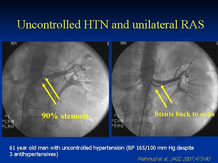 Uncontrolled HTN and unilateral RAS 90% stenosis Stents back to ostia 61 year old