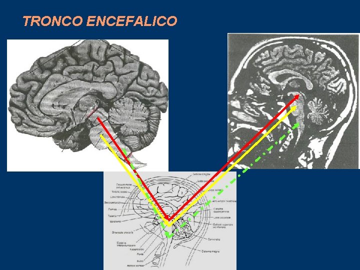 TRONCO ENCEFALICO 