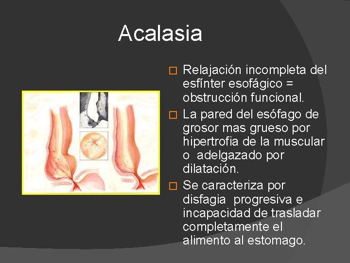Acalasia Relajación incompleta del esfínter esofágico = obstrucción funcional. � La pared del esófago