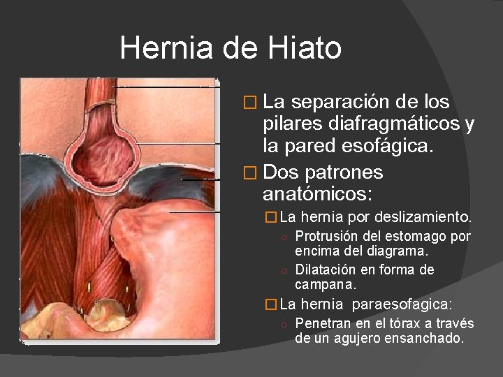 Hernia de Hiato � La separación de los pilares diafragmáticos y la pared esofágica.