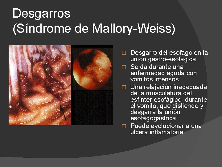 Desgarros (Síndrome de Mallory-Weiss) Desgarro del esófago en la unión gastro-esofagica. � Se da