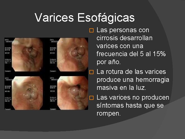 Varices Esofágicas Las personas con cirrosis desarrollan varices con una frecuencia del 5 al