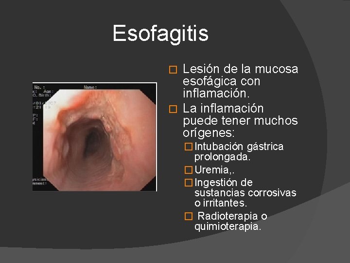 Esofagitis Lesión de la mucosa esofágica con inflamación. � La inflamación puede tener muchos