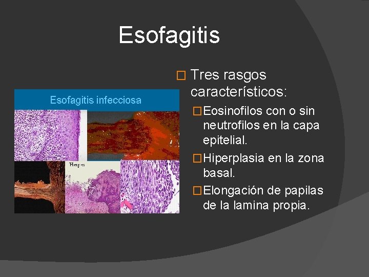 Esofagitis � Tres rasgos característicos: �Eosinofilos con o sin neutrofilos en la capa epitelial.