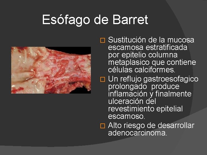 Esófago de Barret Sustitución de la mucosa escamosa estratificada por epitelio columna metaplasico que