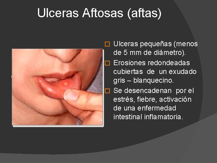 Ulceras Aftosas (aftas) Ulceras pequeñas (menos de 5 mm de diámetro). � Erosiones redondeadas