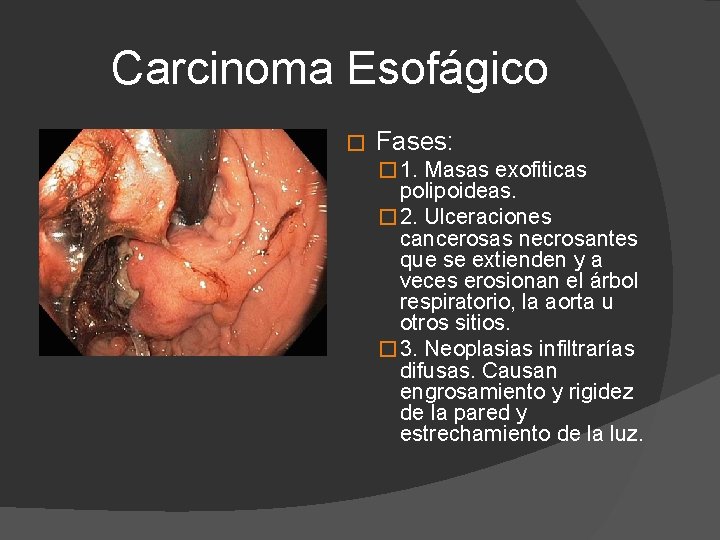 Carcinoma Esofágico � Fases: � 1. Masas exofiticas polipoideas. � 2. Ulceraciones cancerosas necrosantes