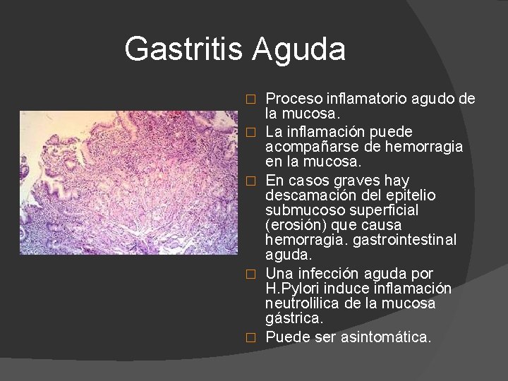 Gastritis Aguda � � � Proceso inflamatorio agudo de la mucosa. La inflamación puede