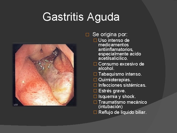 Gastritis Aguda � Se origina por: � Uso intenso de medicamentos antiinflamatorios, especialmente acido