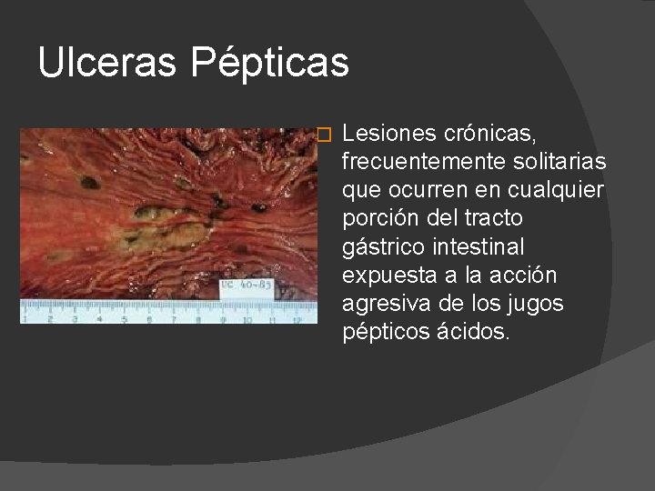 Ulceras Pépticas � Lesiones crónicas, frecuentemente solitarias que ocurren en cualquier porción del tracto