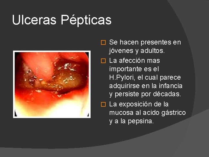 Ulceras Pépticas Se hacen presentes en jóvenes y adultos. � La afección mas importante