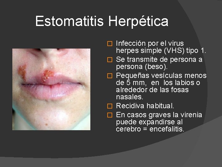 Estomatitis Herpética � � � Infección por el virus herpes simple (VHS) tipo 1.