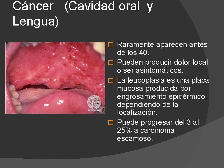 Cáncer (Cavidad oral y Lengua) Raramente aparecen antes de los 40. � Pueden producir