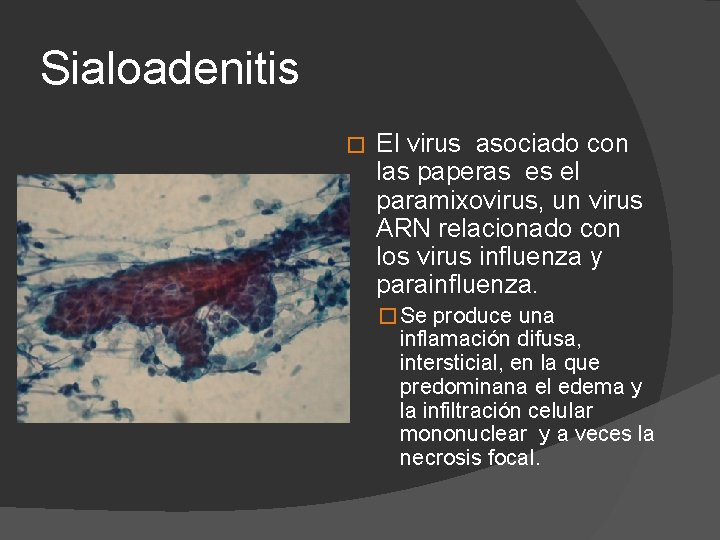 Sialoadenitis � El virus asociado con las paperas es el paramixovirus, un virus ARN
