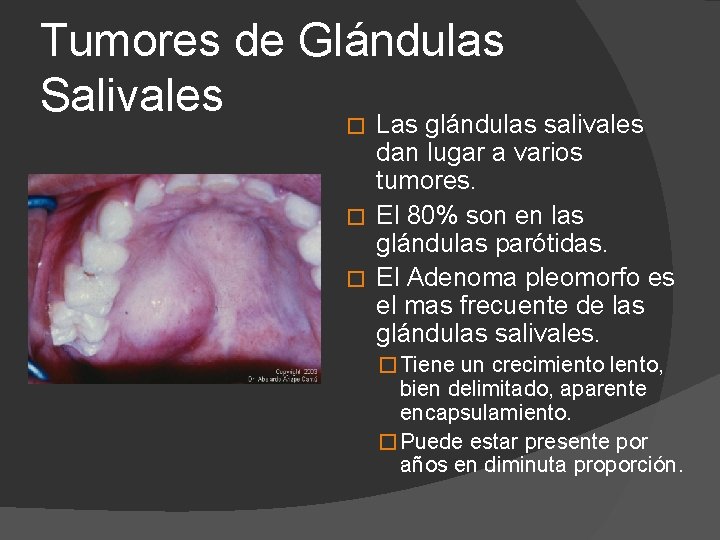 Tumores de Glándulas Salivales � Las glándulas salivales dan lugar a varios tumores. �