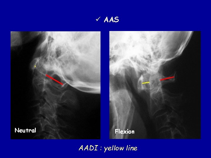 ü AAS Neutral Flexion AADI : yellow line 