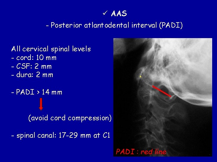 ü AAS - Posterior atlantodental interval (PADI) All cervical spinal levels - cord: 10