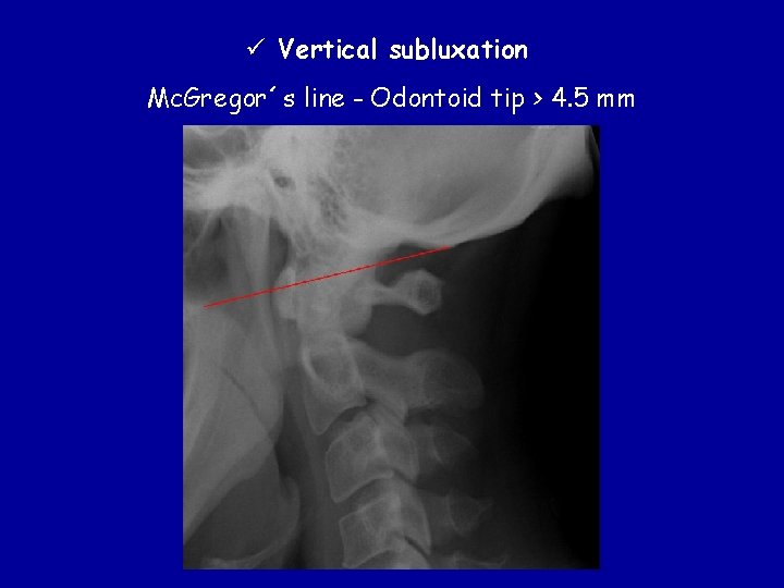 ü Vertical subluxation Mc. Gregor´s line - Odontoid tip > 4. 5 mm 