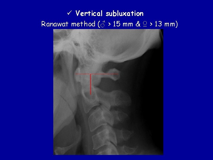 ü Vertical subluxation Ranawat method (♂ > 15 mm & ♀ > 13 mm)