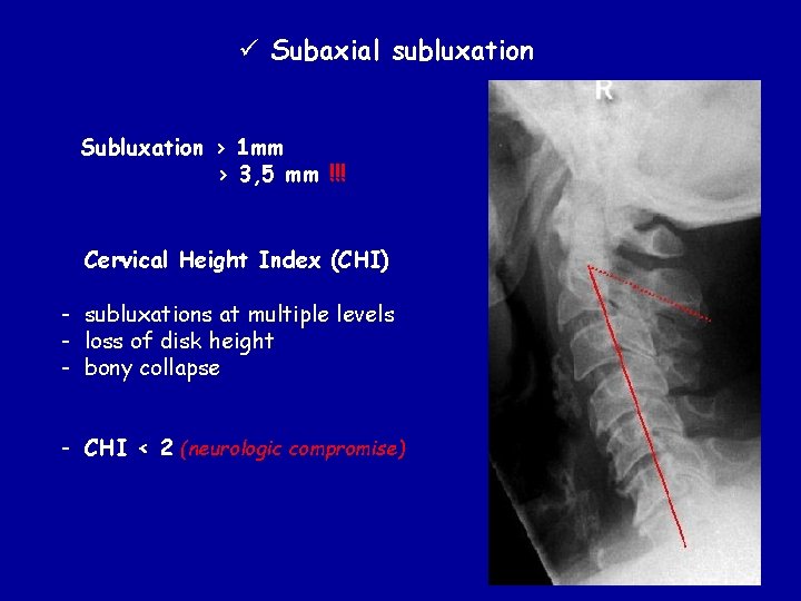 ü Subaxial subluxation Subluxation > 1 mm > 3, 5 mm !!! Cervical Height