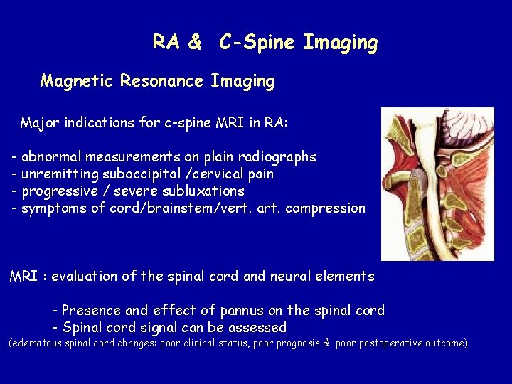 RA & C-Spine Imaging Magnetic Resonance Imaging Major indications for c-spine MRI in RA: