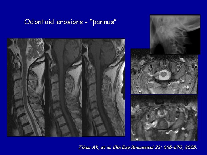 Odontoid erosions - “pannus” Zikou AK, et al. Clin Exp Rheumatol 23: 665 -670,