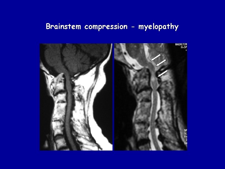 Brainstem compression - myelopathy 