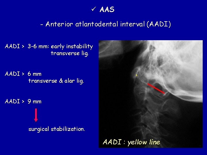 ü AAS - Anterior atlantodental interval (AADI) AADI > 3 -6 mm: early instability