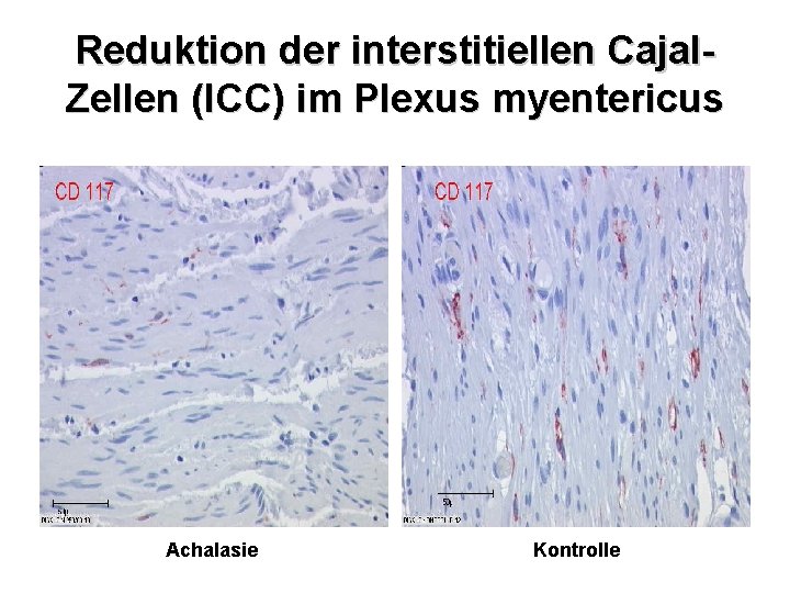 Reduktion der interstitiellen Cajal. Zellen (ICC) im Plexus myentericus Achalasie Kontrolle 