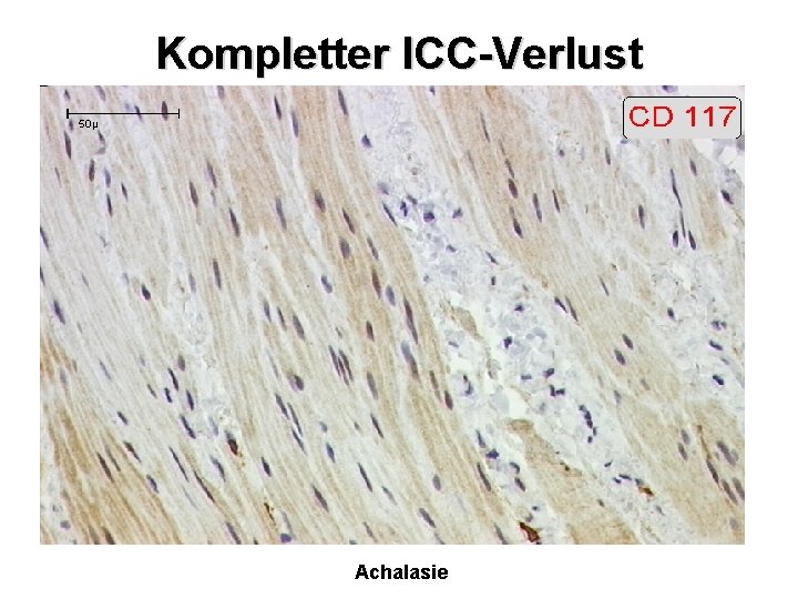 Kompletter l. CC-Verlust Achalasie 