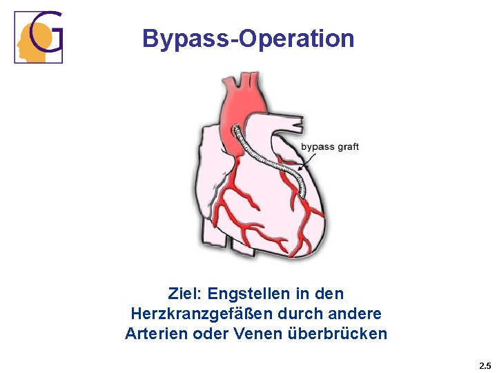 Bypass-Operation Ziel: Engstellen in den Herzkranzgefäßen durch andere Arterien oder Venen überbrücken 2. 5