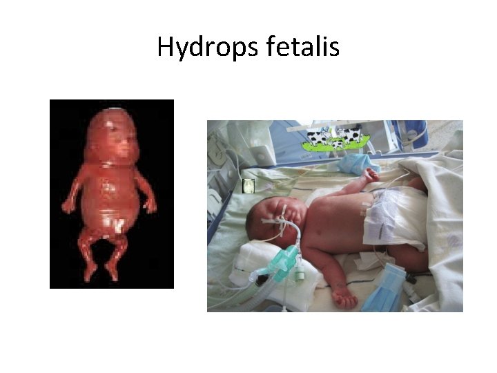 Hydrops fetalis 