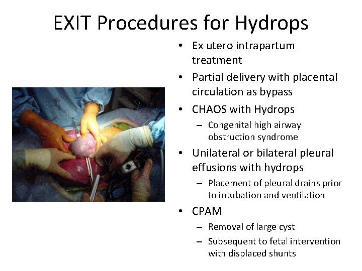 EXIT Procedures for Hydrops • Ex utero intrapartum treatment • Partial delivery with placental