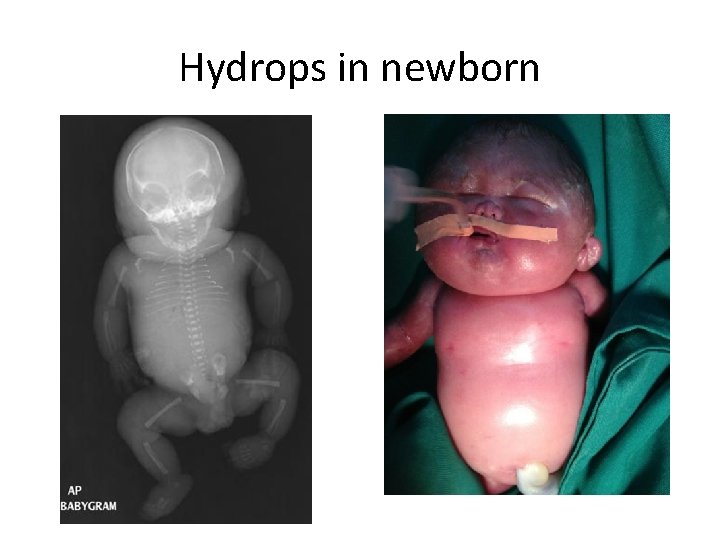 Hydrops in newborn 