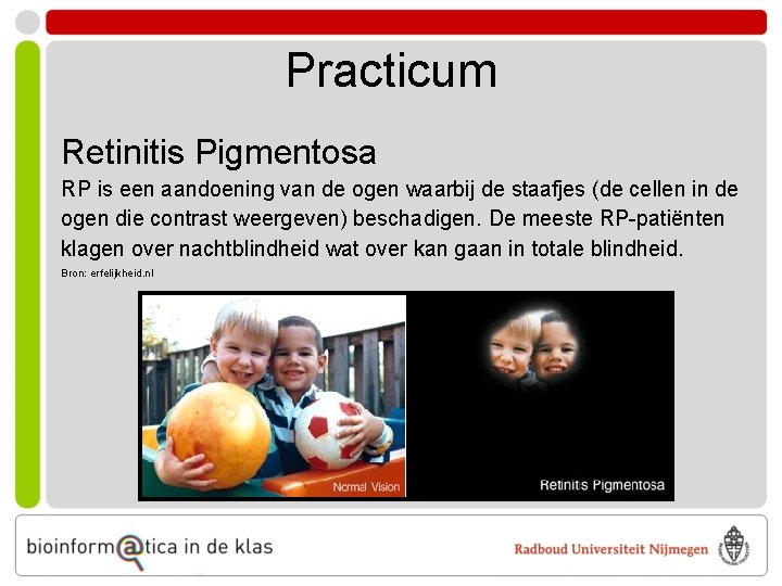 Practicum Retinitis Pigmentosa RP is een aandoening van de ogen waarbij de staafjes (de
