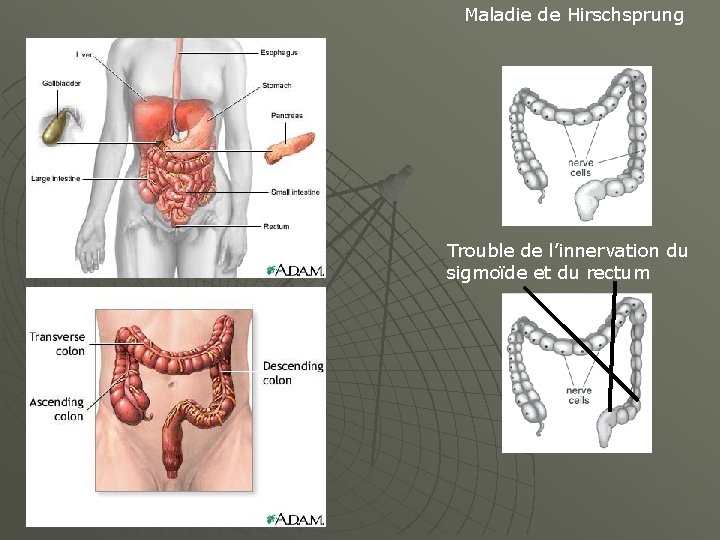 Maladie de Hirschsprung Trouble de l’innervation du sigmoïde et du rectum 