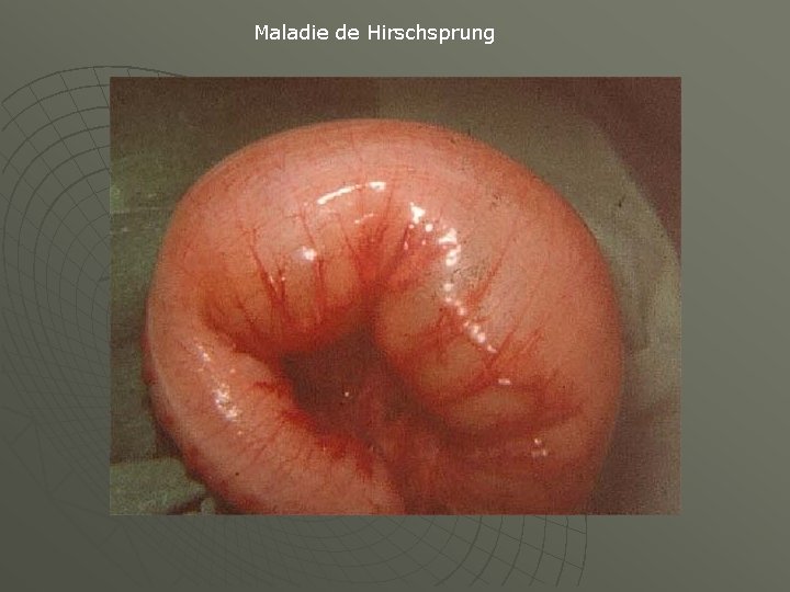 Maladie de Hirschsprung 