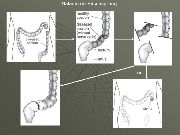 Maladie de Hirschsprung ou 