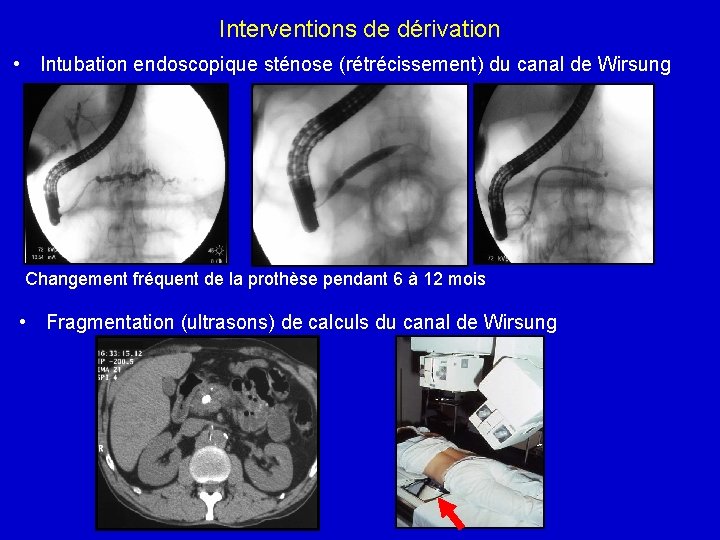 Interventions de dérivation • Intubation endoscopique sténose (rétrécissement) du canal de Wirsung Changement fréquent