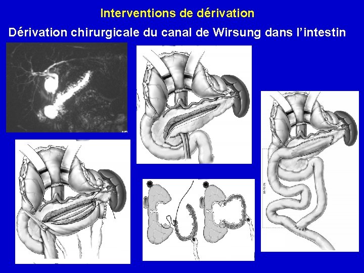 Interventions de dérivation Dérivation chirurgicale du canal de Wirsung dans l’intestin 