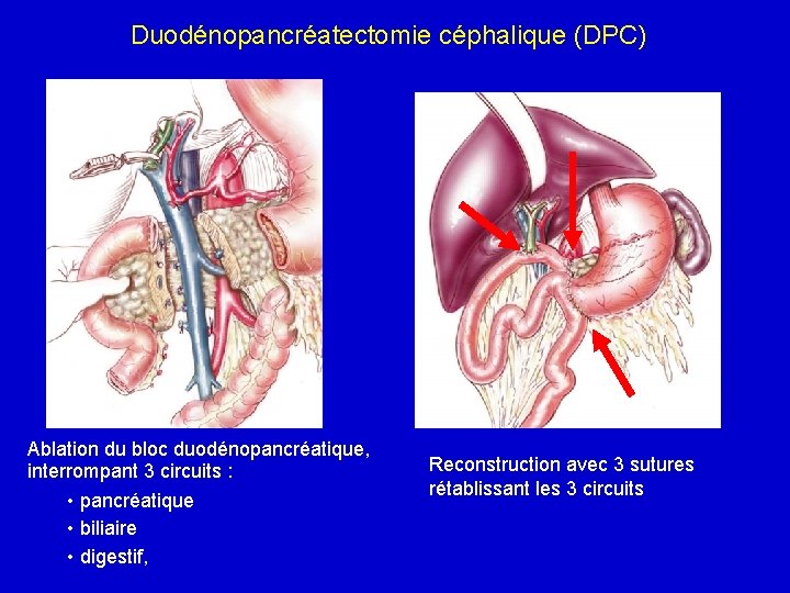 Duodénopancréatectomie céphalique (DPC) Ablation du bloc duodénopancréatique, interrompant 3 circuits : • pancréatique •