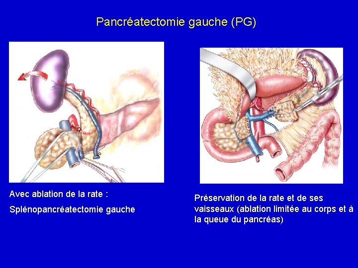 Pancréatectomie gauche (PG) Avec ablation de la rate : Splénopancréatectomie gauche Préservation de la