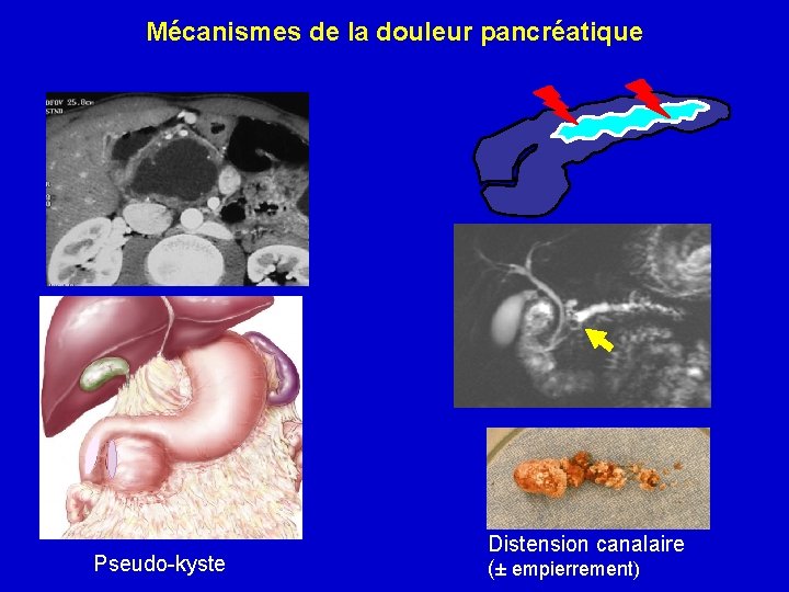 Mécanismes de la douleur pancréatique Pseudo-kyste Distension canalaire (± empierrement) 