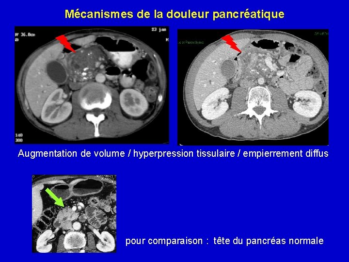 Mécanismes de la douleur pancréatique Augmentation de volume / hyperpression tissulaire / empierrement diffus