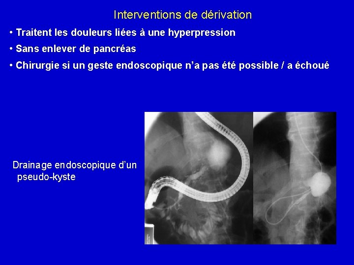 Interventions de dérivation • Traitent les douleurs liées à une hyperpression • Sans enlever