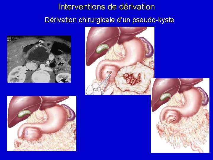 Interventions de dérivation Dérivation chirurgicale d’un pseudo-kyste 