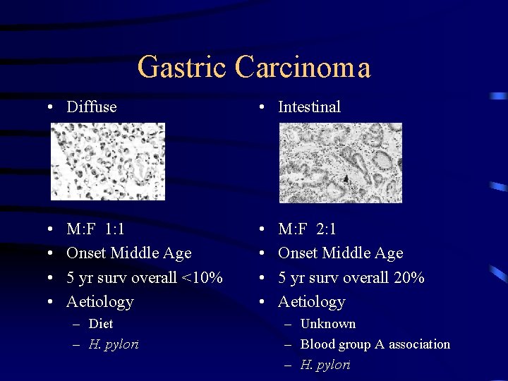 Gastric Carcinoma • Diffuse • Intestinal • • M: F 1: 1 Onset Middle