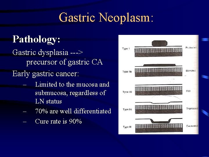 Gastric Neoplasm: Pathology: Gastric dysplasia ---> precursor of gastric CA Early gastric cancer: –